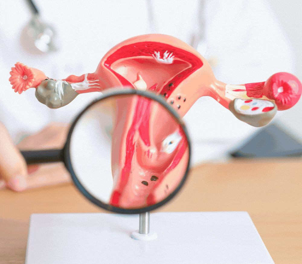 Fibroid treatment in Hyderabad by Dr. Avani Reddy